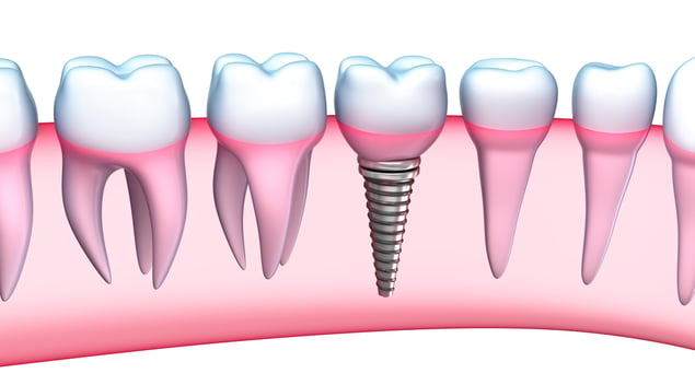 dental_implants_picture